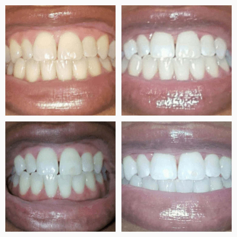 Tanden Bleek Serum Pen