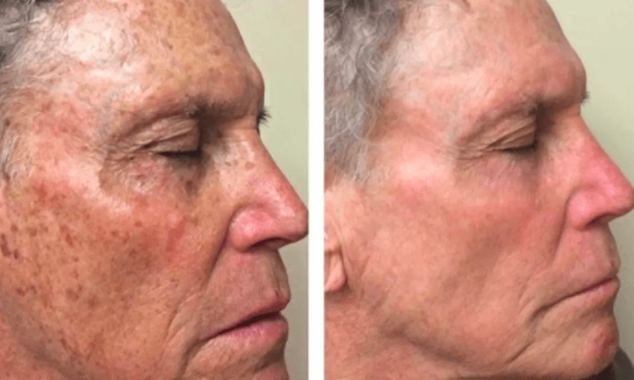 Velier | Dark Spot Peel Off Masker